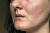 Chemical Peels For Acne Scars: Pros And Cons image 2