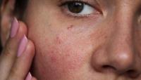 Soothing Your Skin: Rosacea Treatment Explained image 3