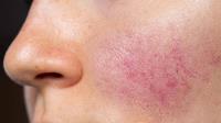 Soothing Your Skin: Rosacea Treatment Explained image 2