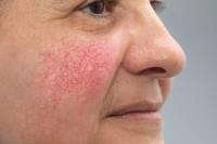 Soothing Your Skin: Rosacea Treatment Explained image 1