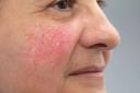 Soothing Your Skin: Rosacea Treatment Explained logo