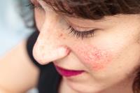Soothing Your Skin: Rosacea Treatment Explained image 5
