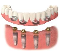 Georgia Implants and Dentures image 8