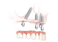 Georgia Implants and Dentures image 10