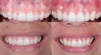 New Dental Implant Smile image 2