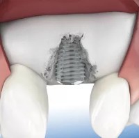 New Dental Implant Smile image 3