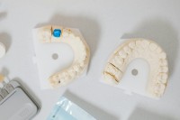 New Dental Implant Smile image 5