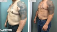 San Antonio Gynecomastia Center image 1