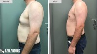 San Antonio Gynecomastia Center image 3