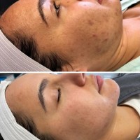 NKD Beauty by Vanessa | Facials | Microneedling  image 3