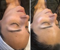 NKD Beauty by Vanessa | Facials | Microneedling  image 4