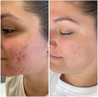 NKD Beauty by Vanessa | Facials | Microneedling  image 5