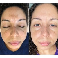 NKD Beauty by Vanessa | Facials | Microneedling  image 6