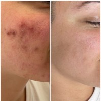 NKD Beauty by Vanessa | Facials | Microneedling  image 7