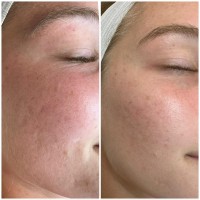 NKD Beauty by Vanessa | Facials | Microneedling  image 8