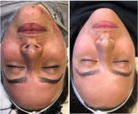 NKD Beauty by Vanessa | Facials | Microneedling  image 9