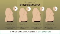 Gynecomastia Center of Boston image 2