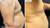 Gynecomastia Center of Boston image 3