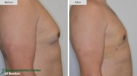 Gynecomastia Center of Boston image 5