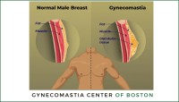 Gynecomastia Center of Boston image 7