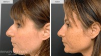 Rhinoplasty Center of Long Island image 7