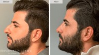 Rhinoplasty Center of Long Island image 9