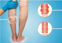 Florida Vein Care Specialists - Apopka image 2