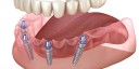 Washington Street Dental Implants logo