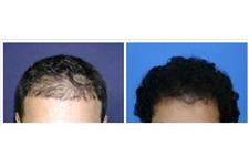 Affordable Hair Transplants San Francisco image 4