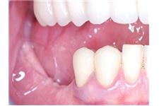 OC Dental Implants image 5