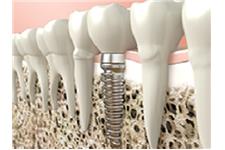 OC Dental Implants image 3