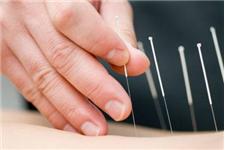 Acupuncture Pain Management image 4