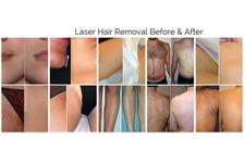 Renova Laser Hair Removal & MedSpa image 4