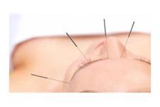 Olo Acupuncture image 11