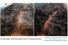 PRP Hair MD New Jersey image 2