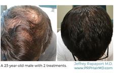 PRP Hair MD New Jersey image 4