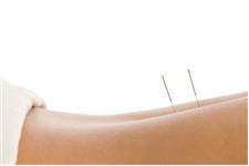 Total Wellness Acupuncture image 2