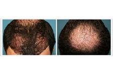 Affordable Hair Transplants Boca Raton image 3