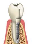 First Class Dental Implants image 1