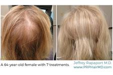 PRP Hair MD New Jersey image 3