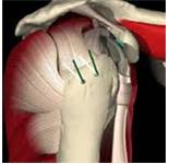OrthoTexas - Shoulder Pain Irving image 5