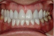 Prosthodontics & Implants Northwest image 4
