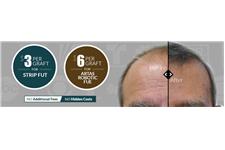 Affordable Hair Transplants Boca Raton image 4