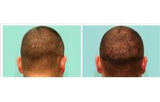 Affordable Hair Transplants Los Angeles image 2