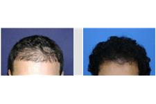 Affordable Hair Transplants Minneapolis image 4