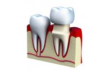 Dental Impressions image 4