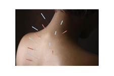 Olo Acupuncture image 8