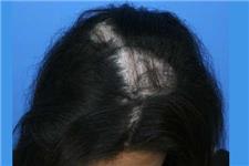 Affordable Hair Transplants Charlotte image 2