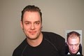 Samson Hair Transplant image 2