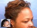 Samson Hair Transplant image 5